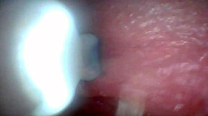 Penis Endoscope View!